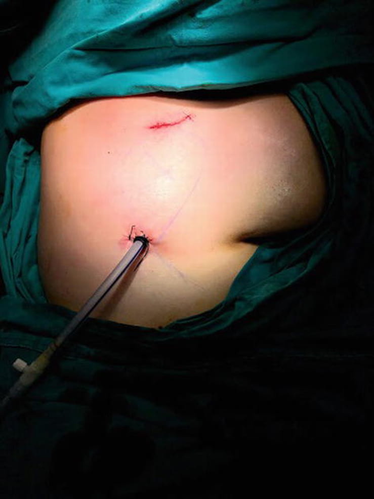 Resim: Ameliyat sonu insizyonların görünümü