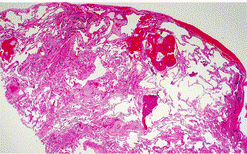 RESİM 4: İPF in torakoskopik biyopsi sonucu histopatolojik görünümü
